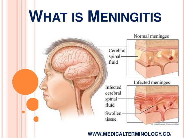apa itu meningitis